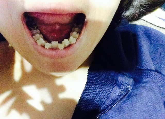 歯科矯正